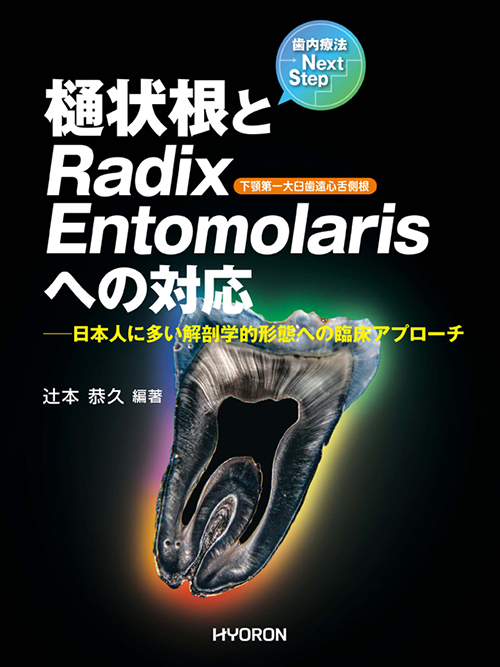 歯内療法Next Step　樋状根とRadix Entomolarisへの対応